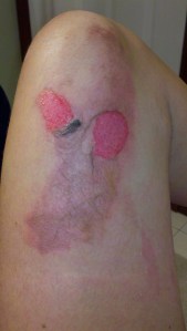 Here's the view of my burn two days after.